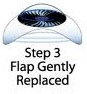 flap gently replaced in lasik procedure