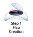 Creation of flap in the eye